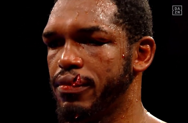 Tureano Johnson suffered one a gruesome cut at the hands of  Jaime Munguia last night.