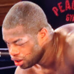 Dubois suffered a fractured eye socket and nerve damage Photo Credit: essentiallysports.com