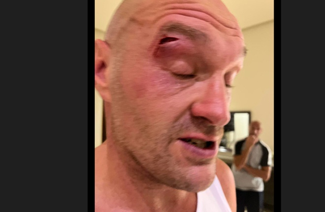 Fury suffered a gruesome cut in sparring which ruled him out of fighting Usyk on February 17 Photo Credit: Queensberry Promotions/Sky Sports